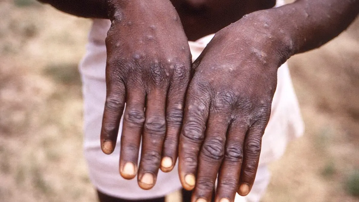 El Congo está sufriendo el mayor brote de mpox de su historia que pronto podría extenderse a EE.UU.