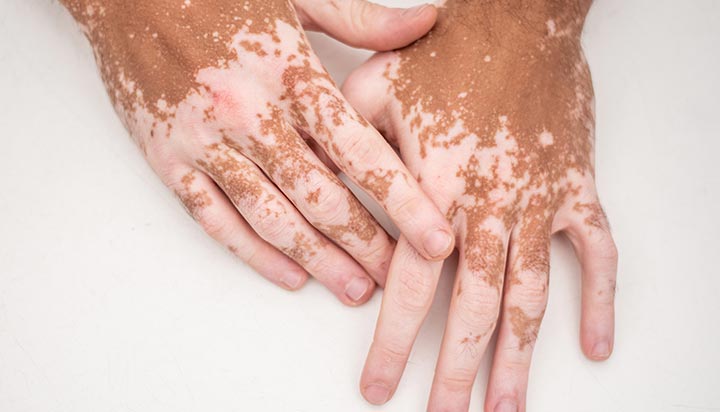 Día Mundial del Vitiligo: cuatro claves sobre esta condición que afecta la pigmentación de la piel