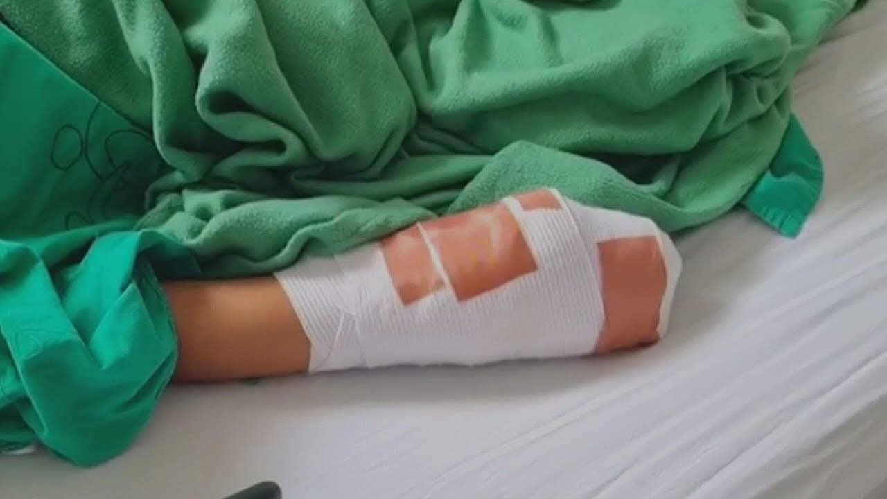 ¡Lamentable! Niño pierde la mano derecha por explosión de mortero en Roatán