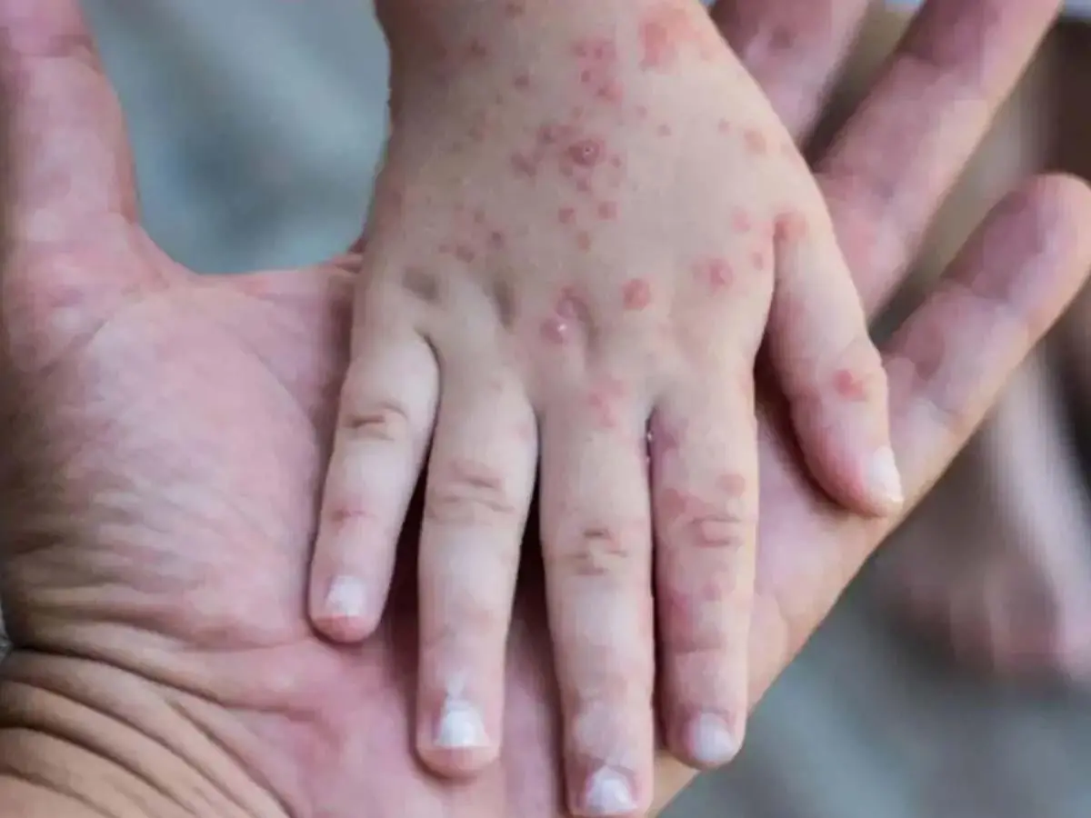 Sarampión supera al COVID-19 en capacidad de contagio y enciende las alertas sanitarias en Honduras